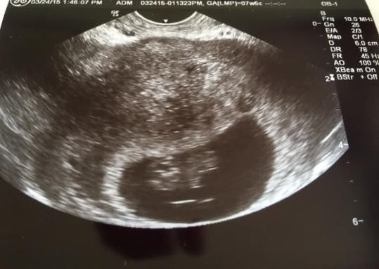  photo ultrasound without name March 15-smaller_zpsxmf3zbxx.jpg